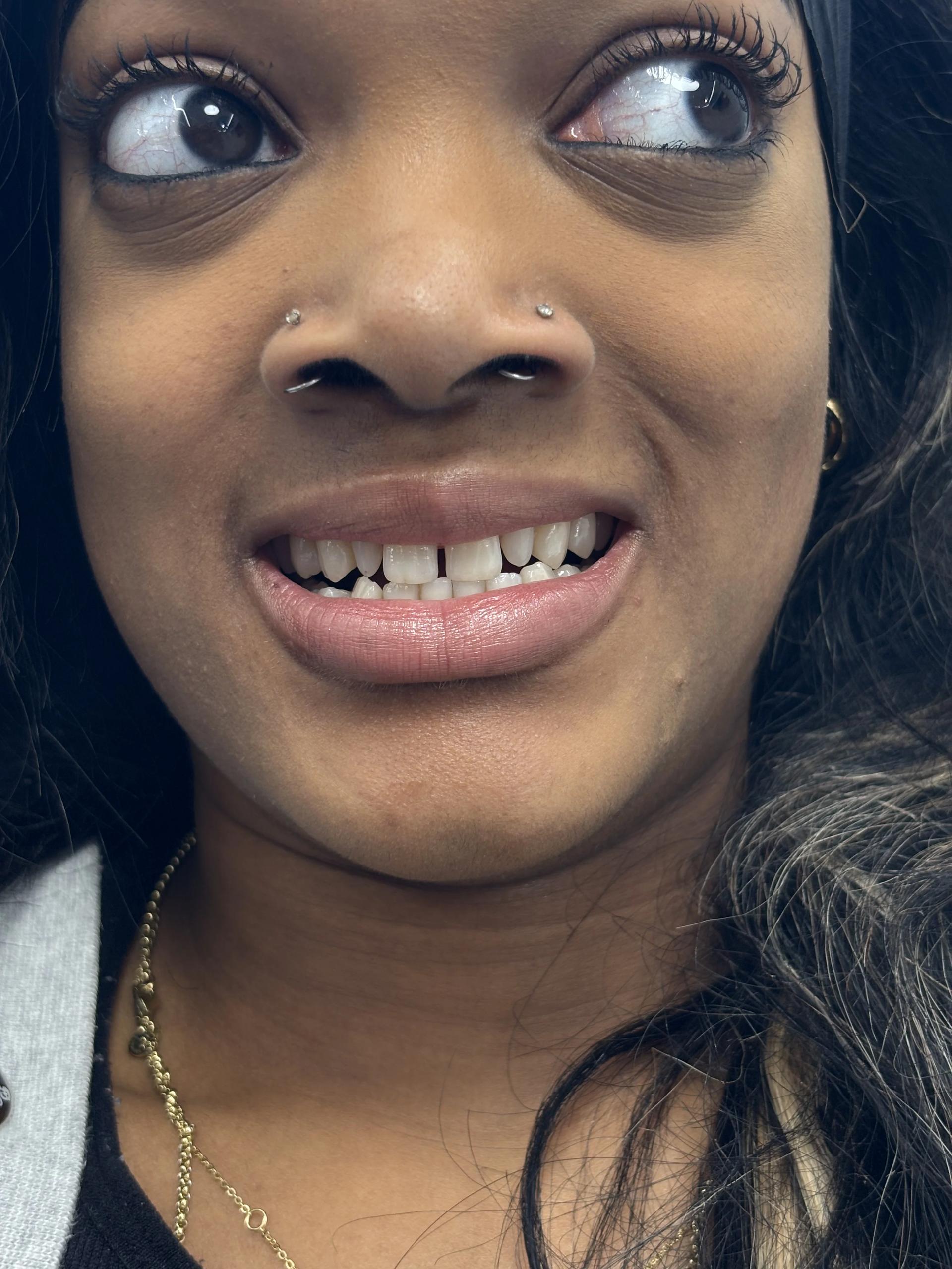 Smile makeover after — NexWell partner clinic, Istanbul