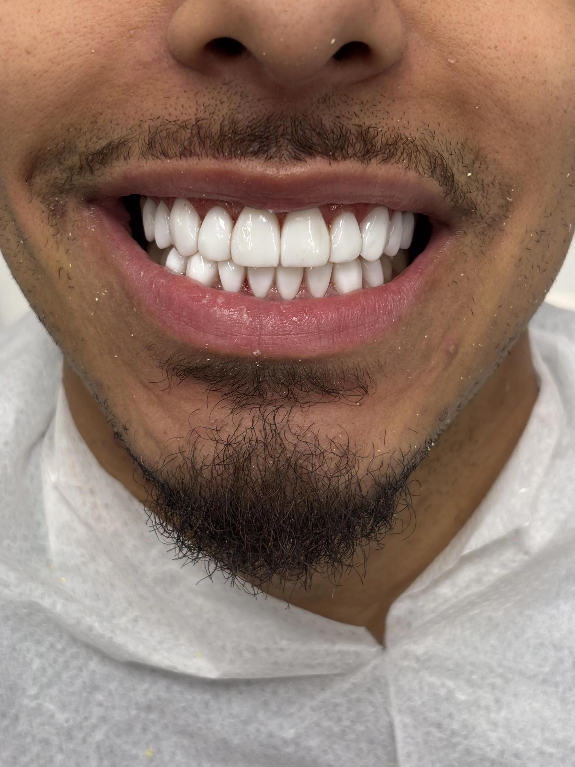 Composite bonding after — case 13, Istanbul NexWell