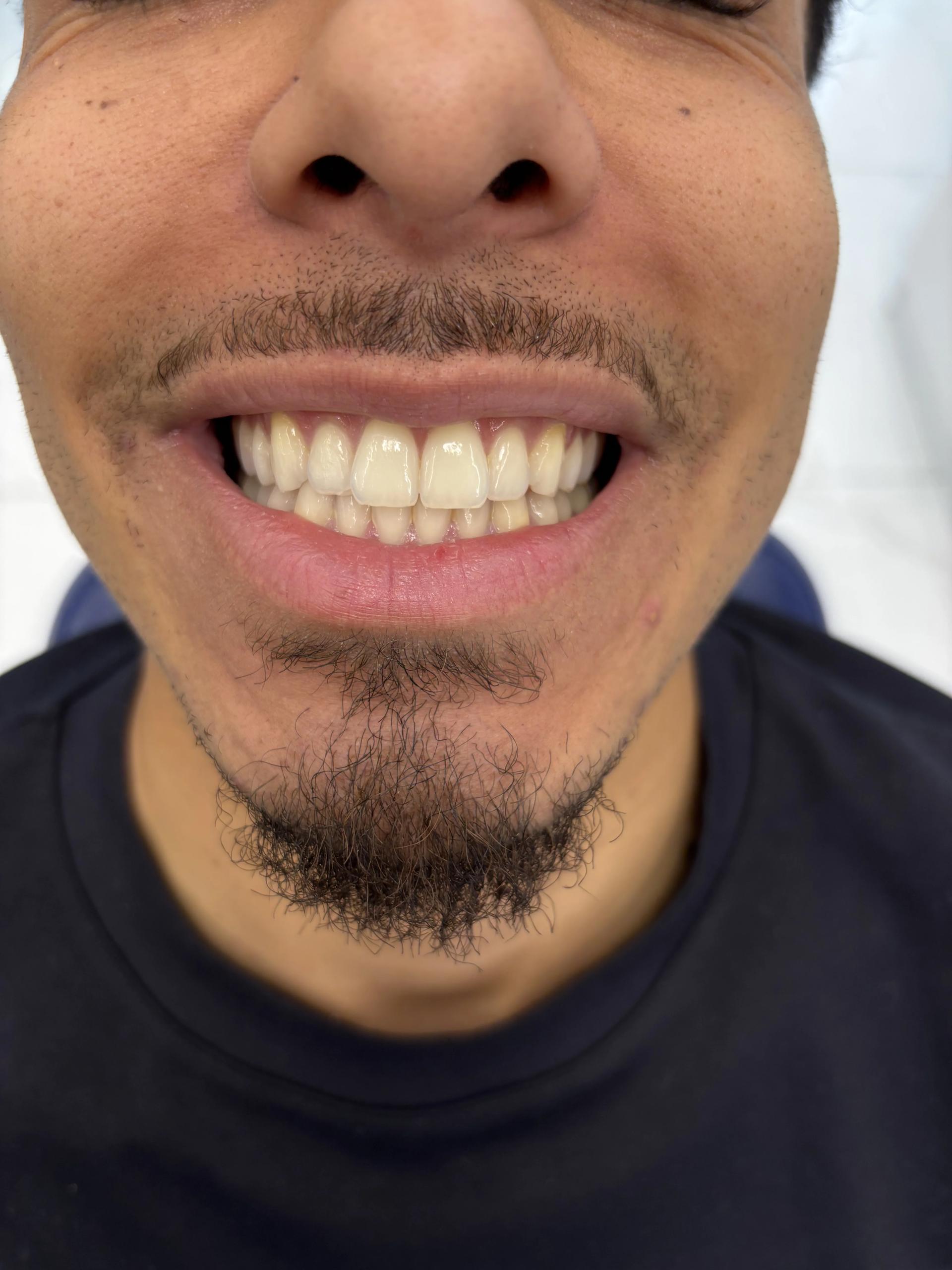 Composite bonding before — case 13, Istanbul
