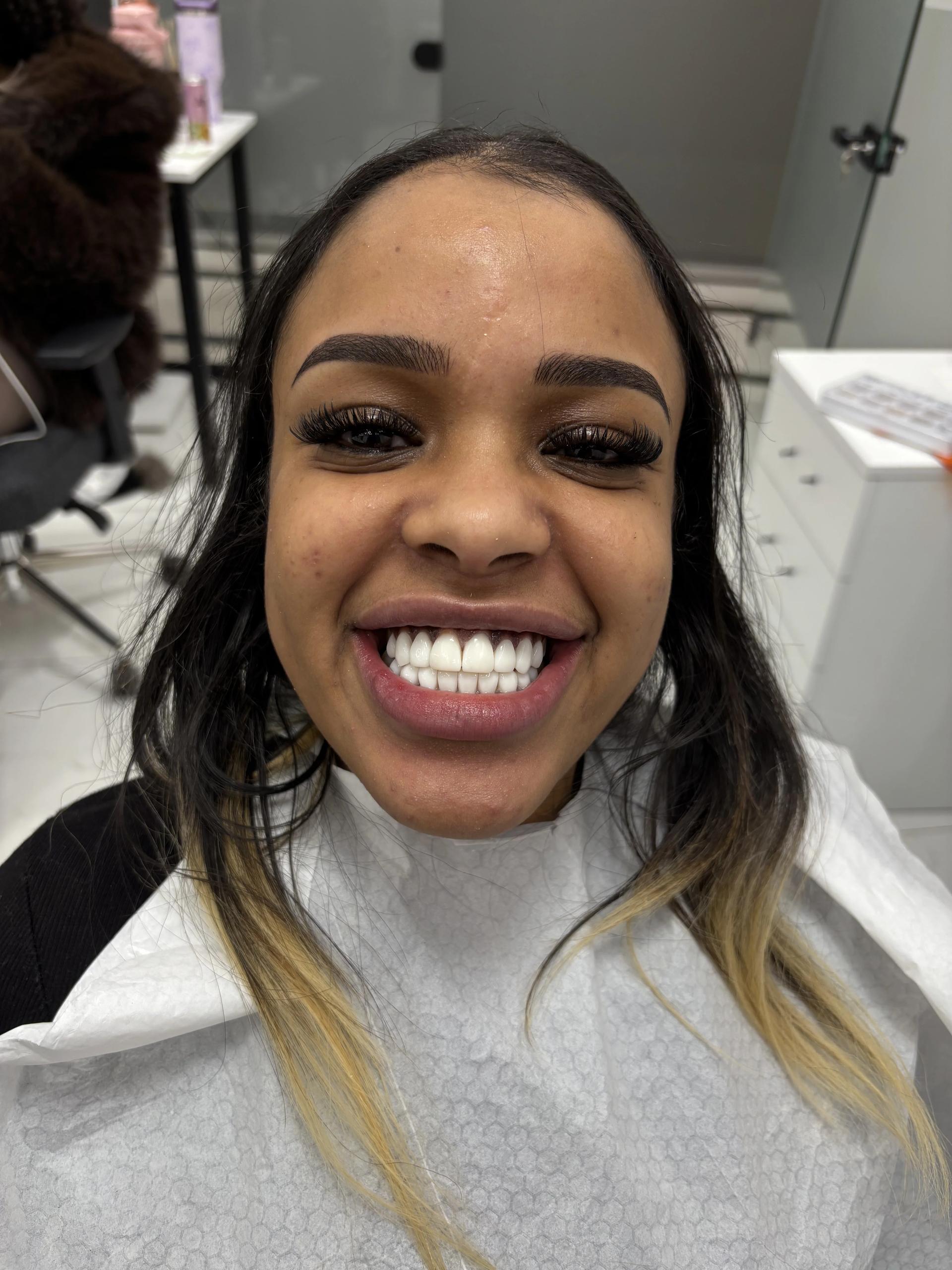 Composite bonding after — case 18, Istanbul NexWell