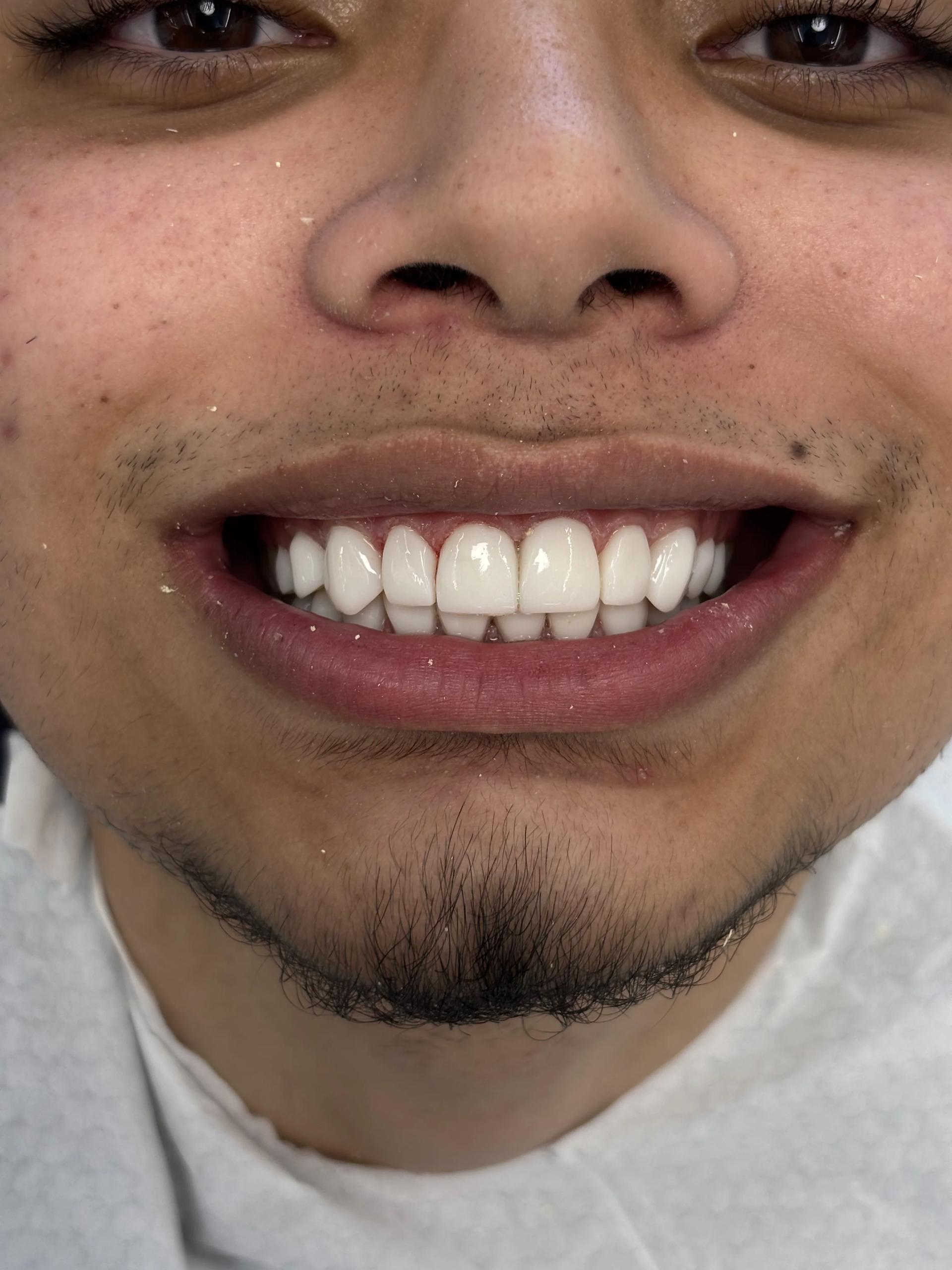 Composite bonding after — case 22, Istanbul NexWell