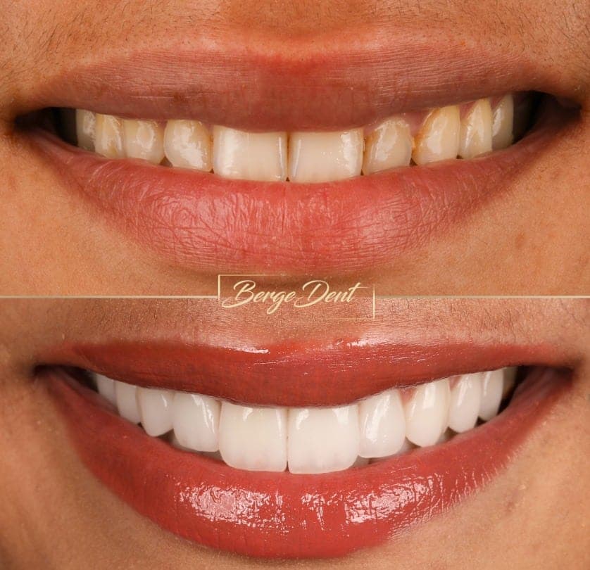 Corticobasal Implants for Full Mouth Restoration