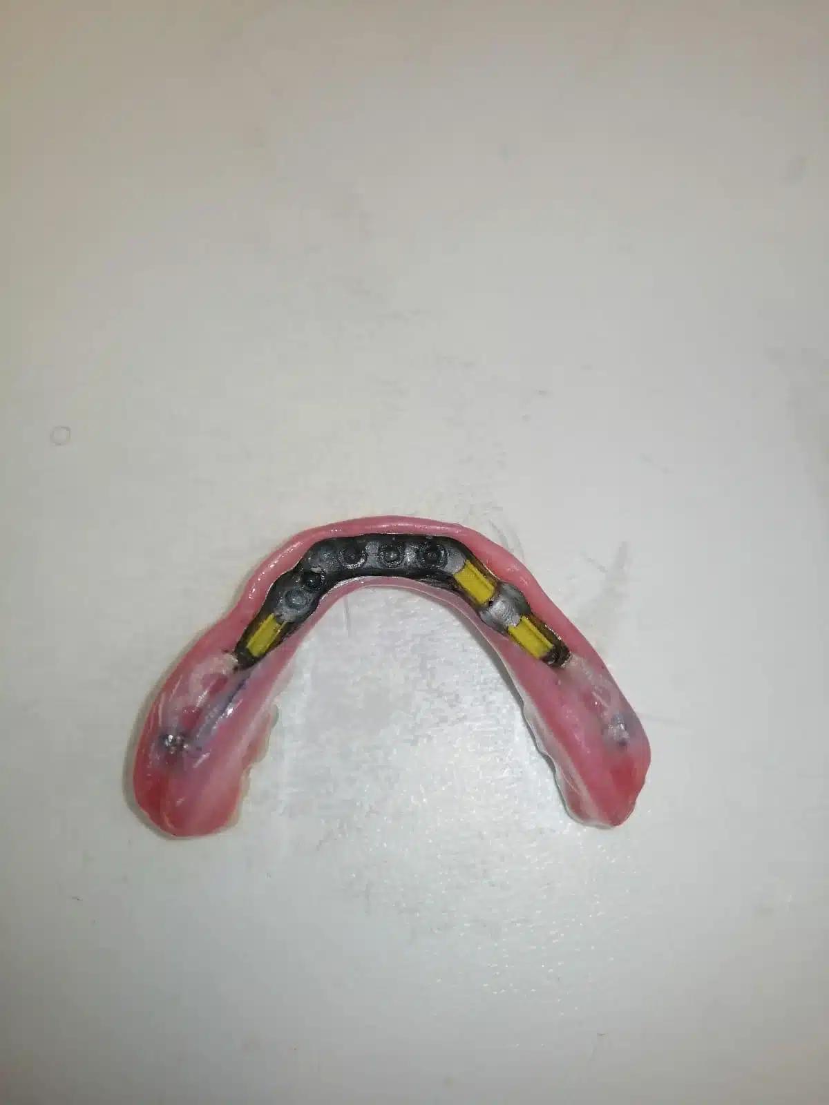 3-Day Full Mouth Restoration With Corticobasal Implants