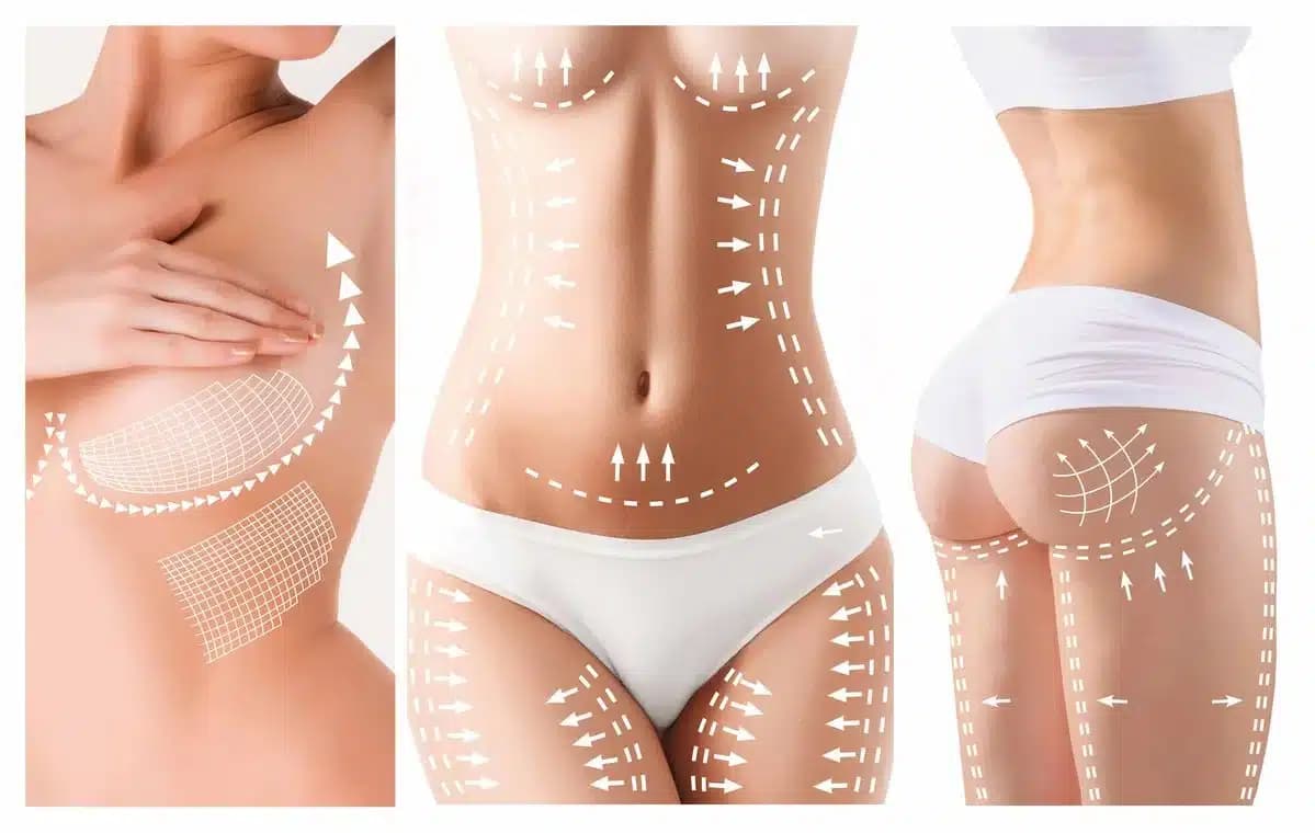Post-weight-loss patient showing abdominal skin laxity