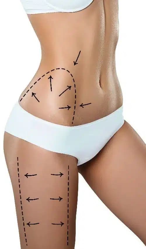 Diagram of circumferential lower body lift technique