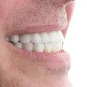 all on 4 full mouth dental implants in turkey