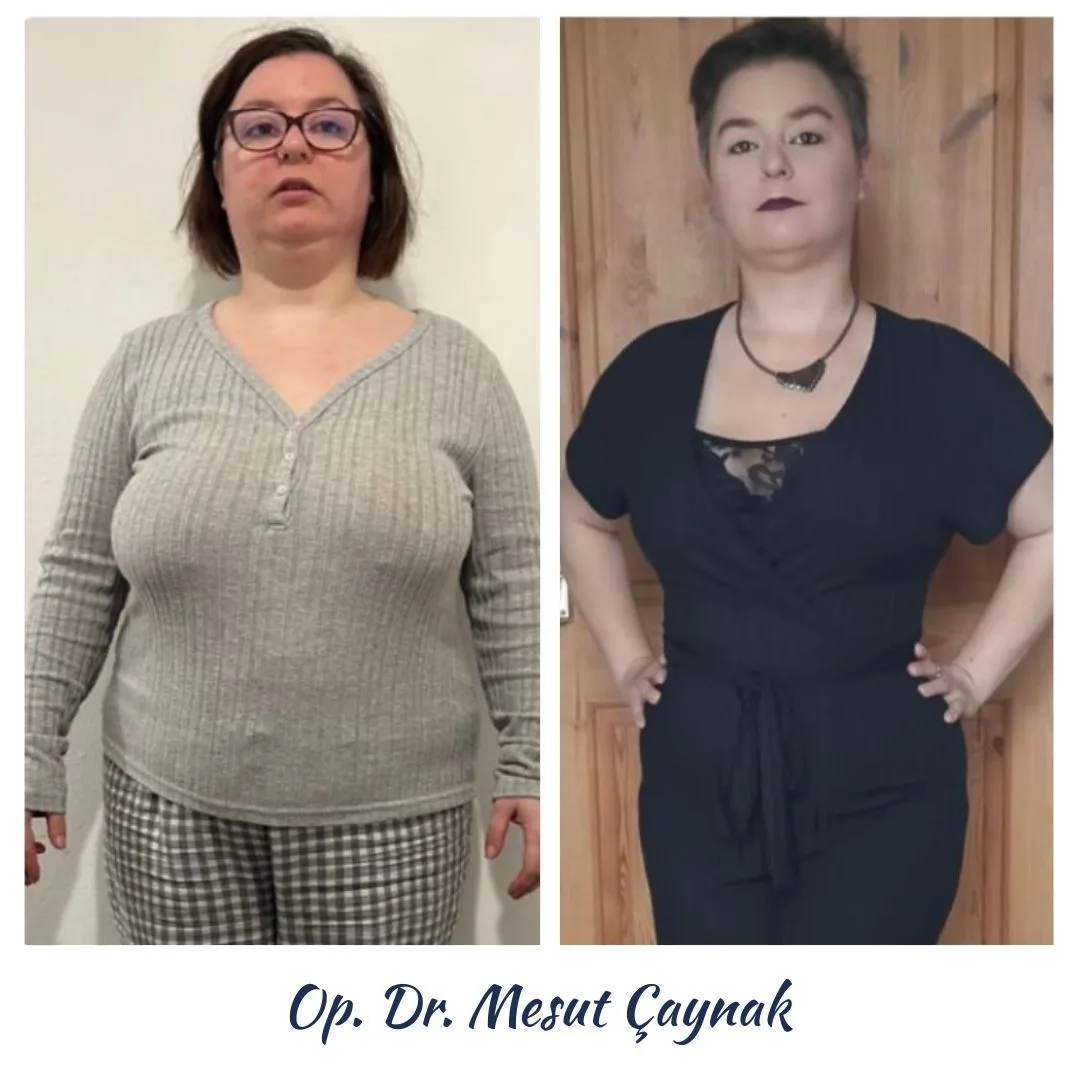 Patient before and after weight-loss surgery, photo 1