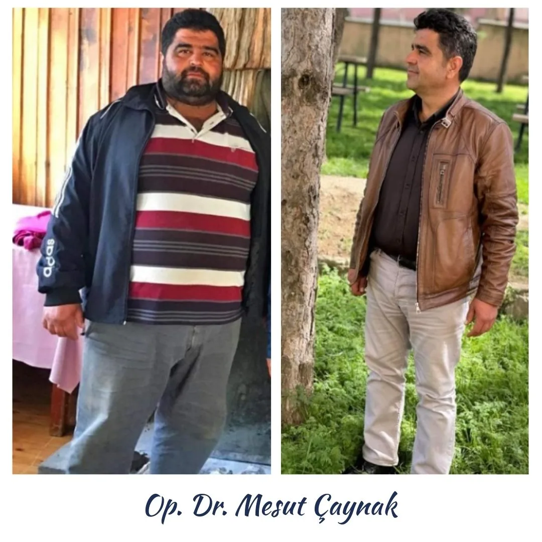 Patient before and after weight-loss surgery, photo 2