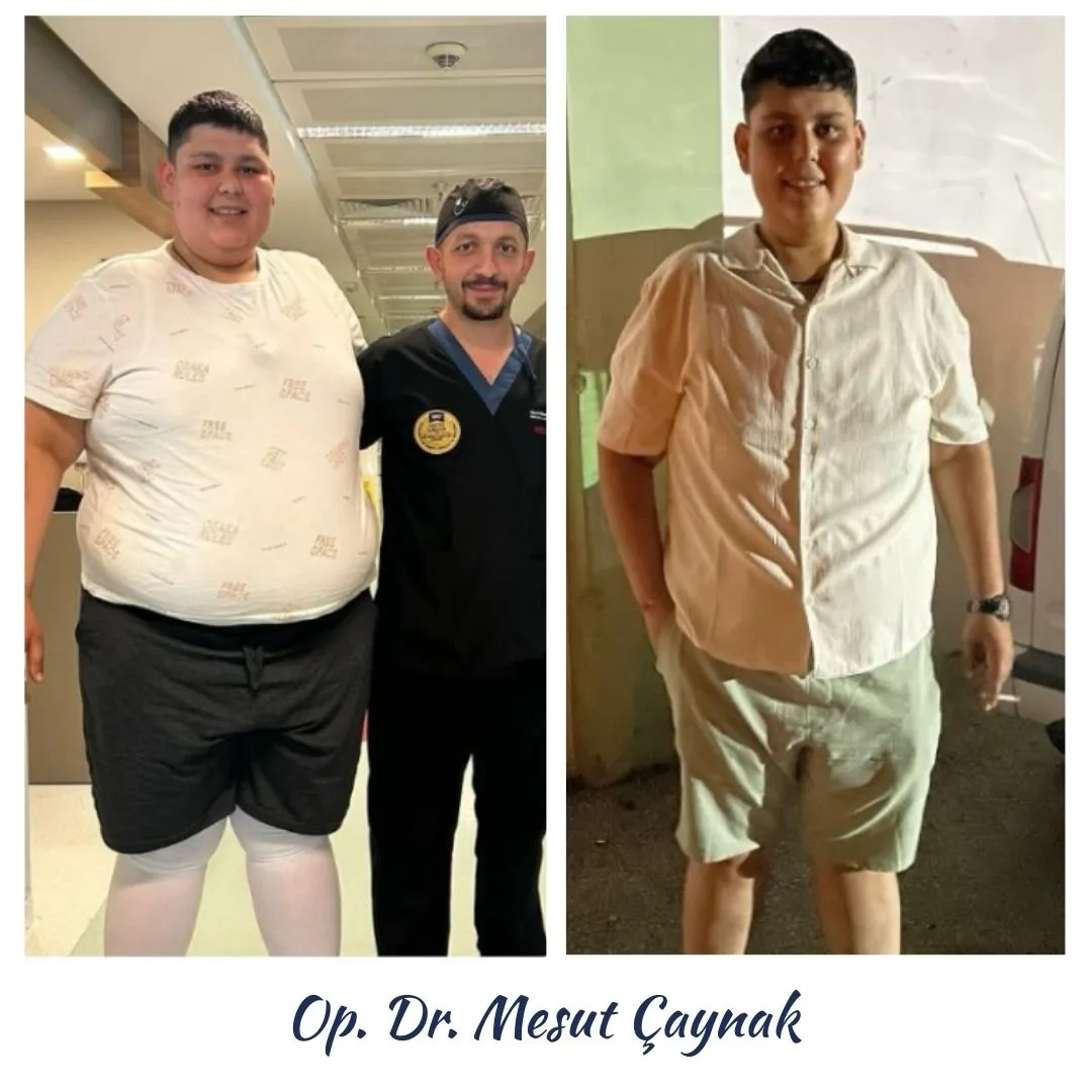 Patient before and after weight-loss surgery, photo 3