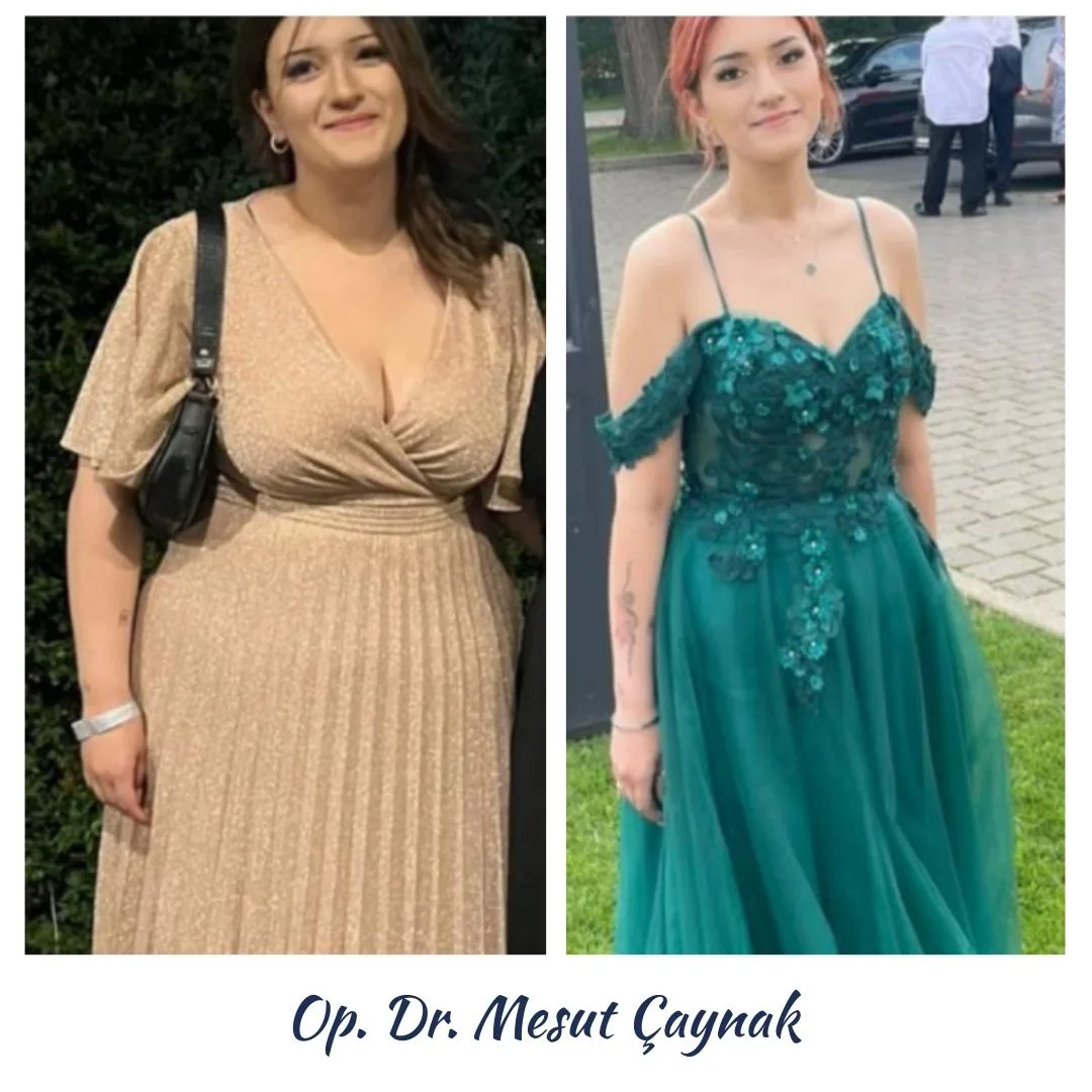 Patient before and after weight-loss surgery, photo 4