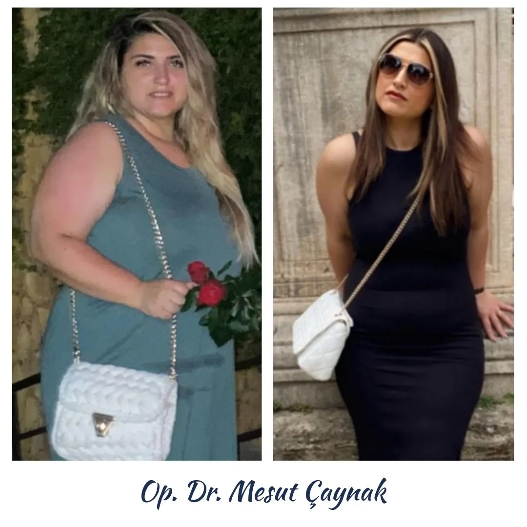 Patient before and after weight-loss surgery, photo 5