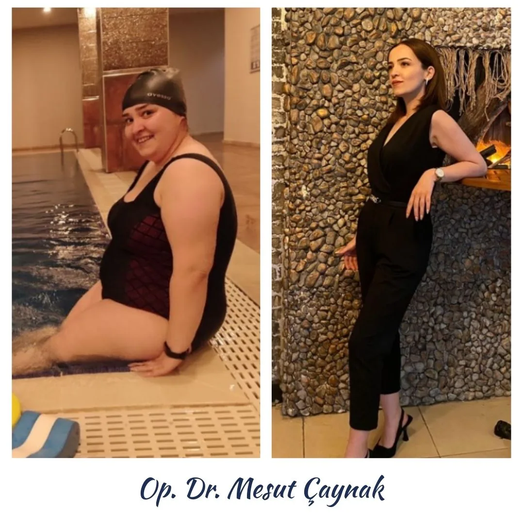 Patient before and after weight-loss surgery, photo 6