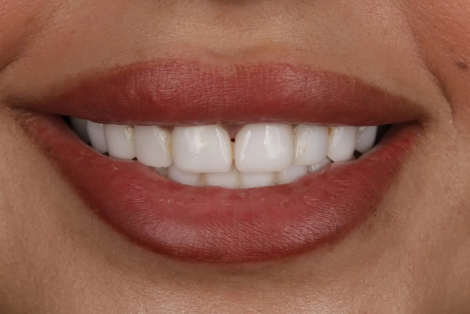 Before and after dental treatment, close-up comparison of natural versus white porcelain veneer teeth, Turkey dental clinic.
