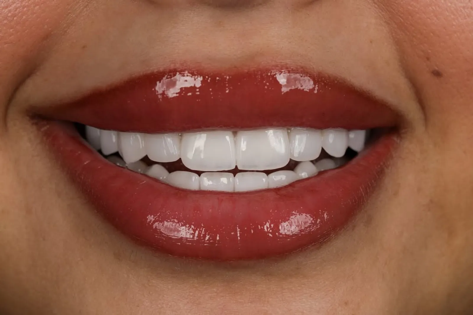 Porcelain veneers after result, close-up of white natural-looking smile, Turkey dental clinic.