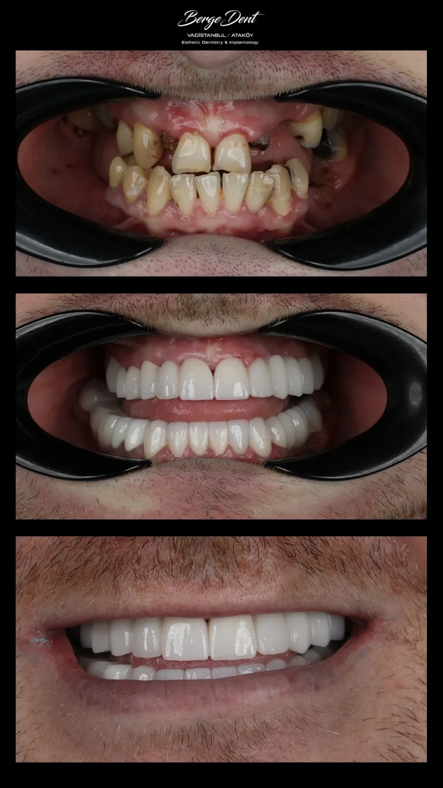 Before and after dental restoration comparison, close-up of upper and lower teeth with cheek retractor, showing transformation from worn discolored teeth to a white ceramic restoration, Turkey dental clinic.