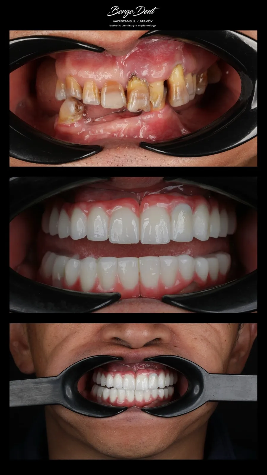 Close-up before and after dental restoration photos showing severely worn decayed teeth transformed into white ceramic crowns, Turkey dental clinic case.