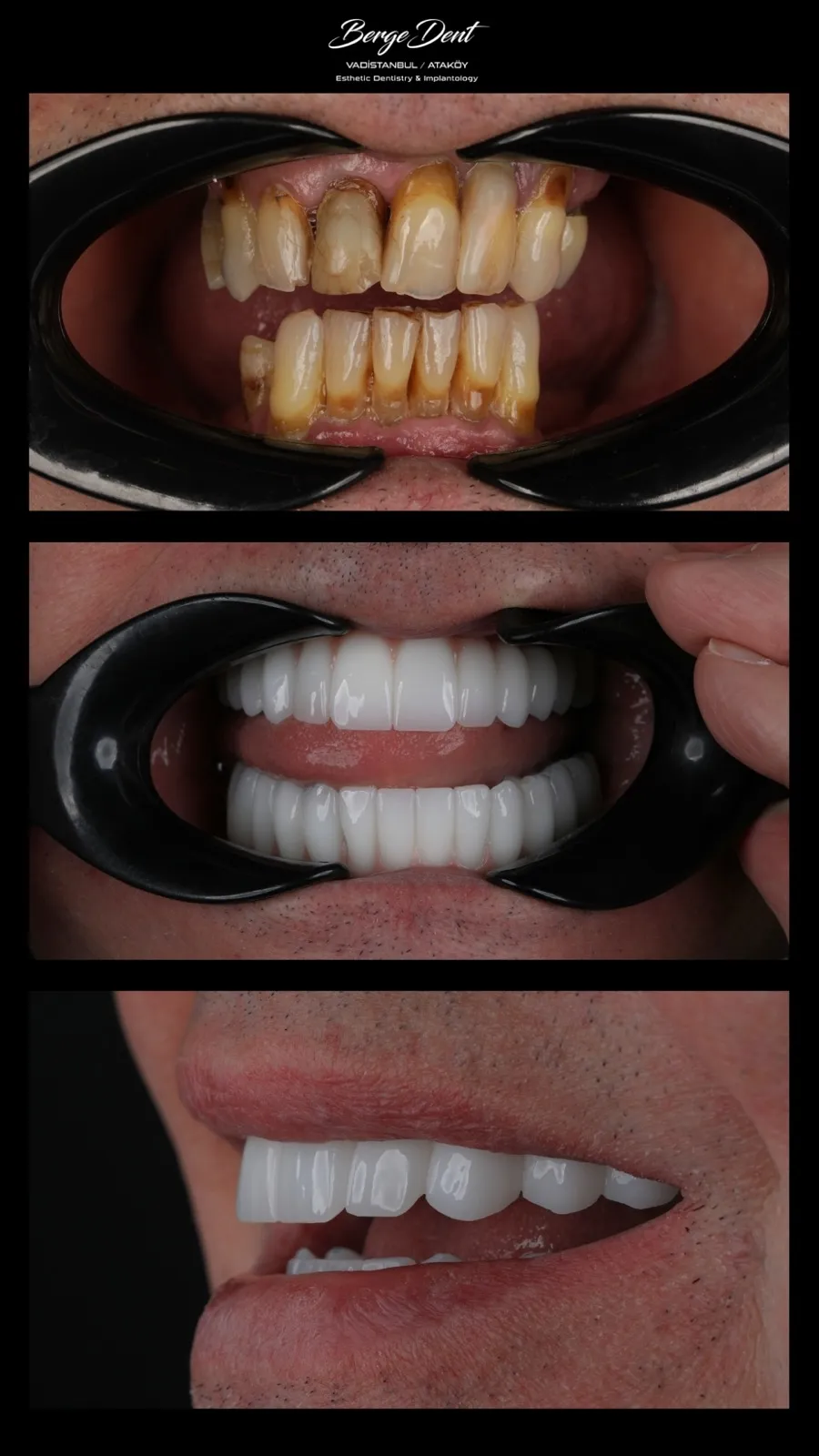 Before and after intraoral dental photos showing transformation from chipped worn teeth to a bright white ceramic restoration, close-up with cheek retractor, Turkey dental clinic.