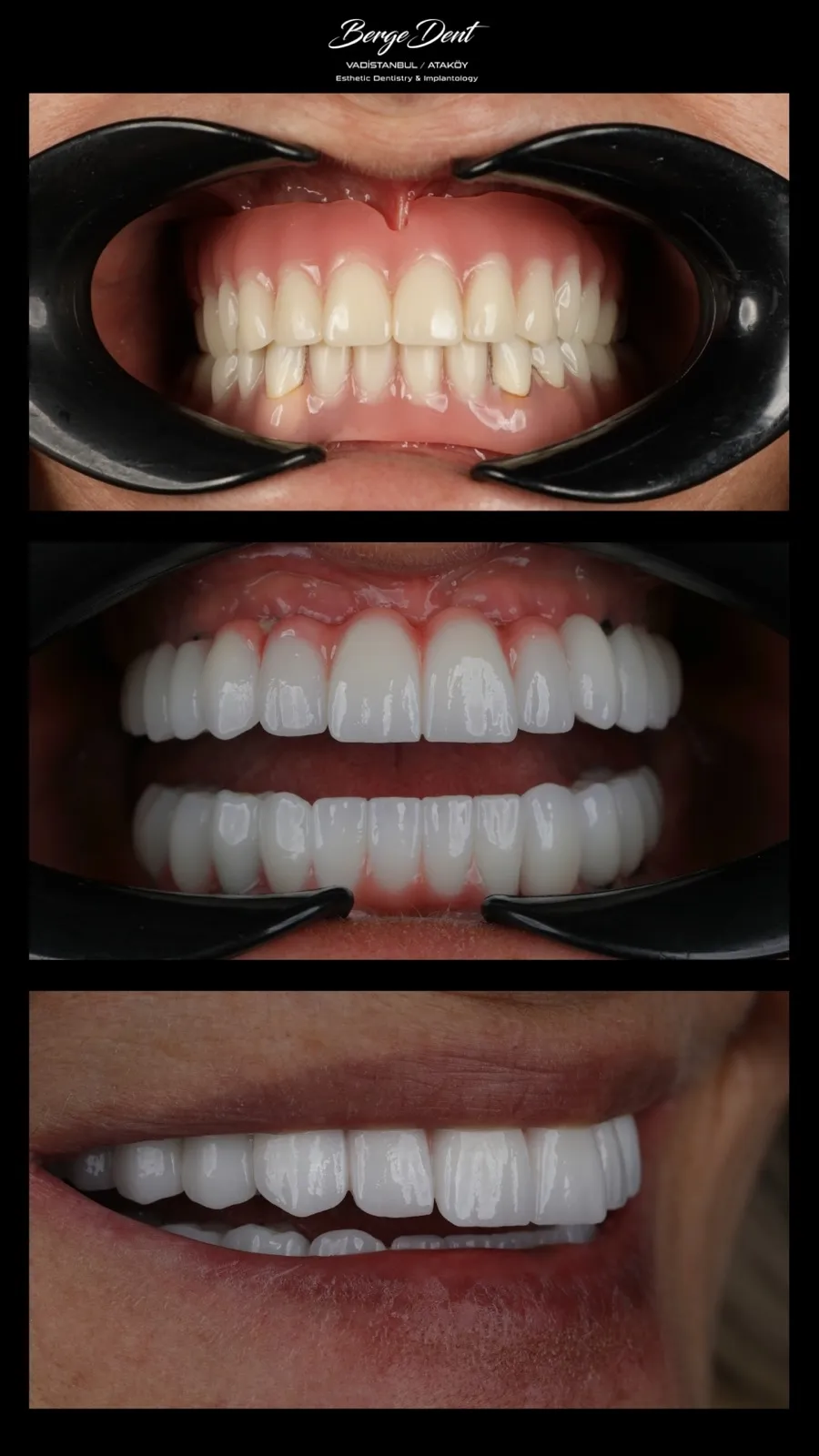 Close-up before and after dental restoration images showing severely damaged teeth transformed into a full set of white ceramic crowns, Turkey dental clinic case.