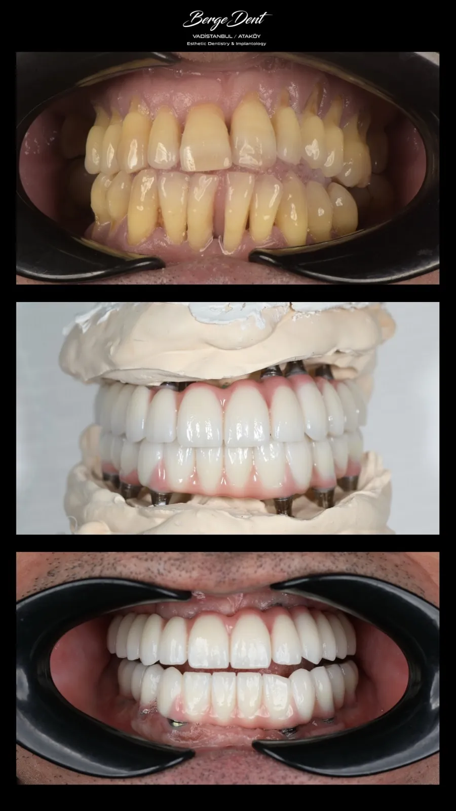 Before and after dental restoration set showing worn discolored teeth, a laboratory model of an implant-supported prosthesis on a titanium bar, and the final white ceramic result in the mouth, Turkey dental clinic.