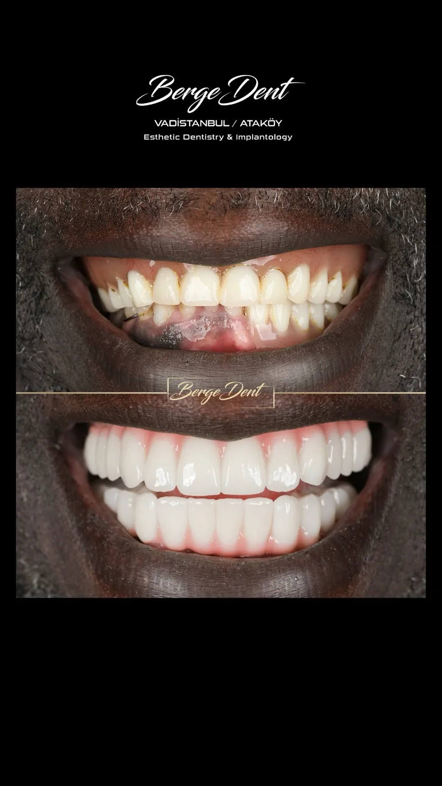 Before and after full face and smile comparison showing a patient's damaged, discolored teeth transformed into a bright white smile after dental restoration, Turkey dental clinic case.