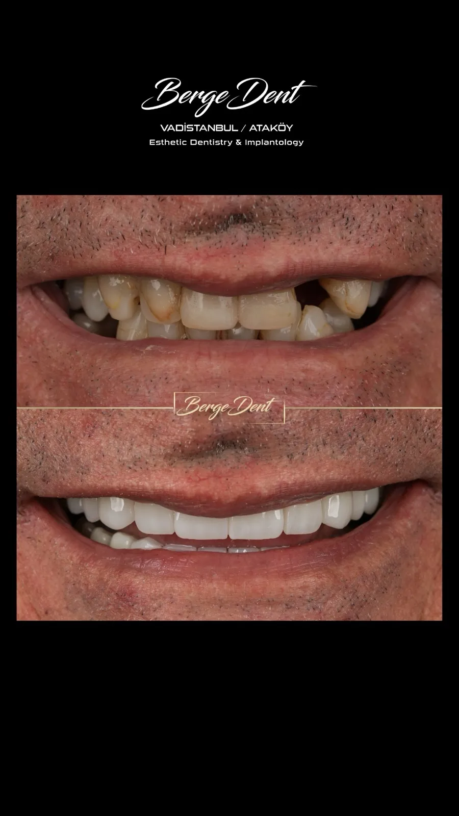 Close-up before and after dental restoration comparison showing chipped, worn teeth transformed into a full set of white ceramic crowns, Turkey dental clinic photo.