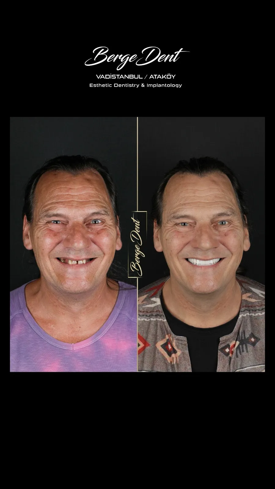 Before and after full face portraits showing a patient's smile transformed from missing and misaligned teeth to a complete white smile after dental restoration, Turkey dental clinic case.
