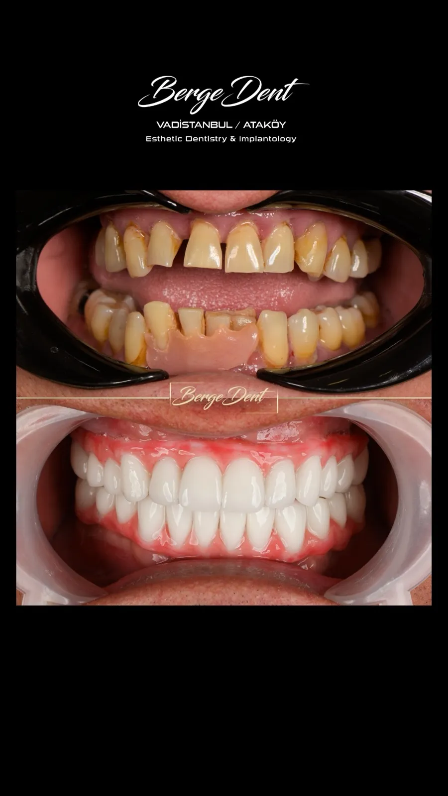 Close-up before and after intraoral dental photos showing badly damaged and discolored teeth transformed into a full arch of white ceramic crowns, Turkey dental clinic.