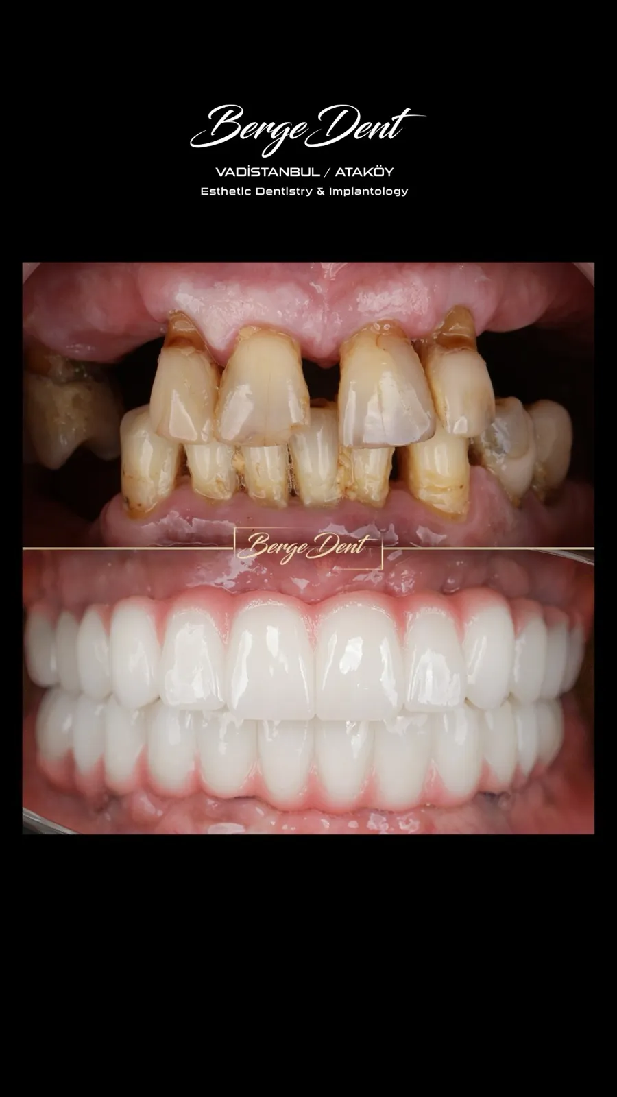 Extreme close-up before and after dental photos showing severely worn and decayed teeth transformed into a bright white ceramic restoration, Turkey dental clinic case.
