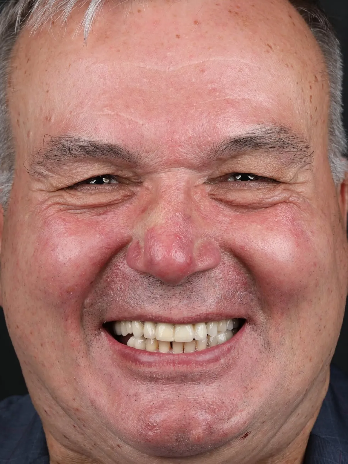 Before and after close-up smile photo showing a patient's teeth transformed from worn and gapped to a bright white even smile, Turkey dental clinic case.