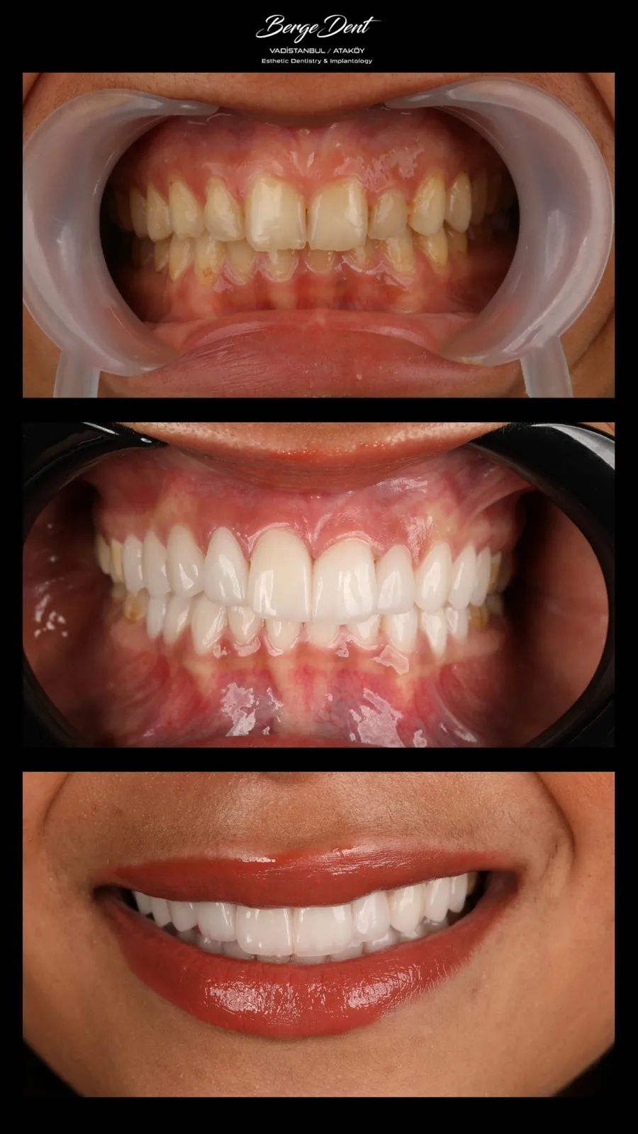 Dental before and after close-up showing discolored teeth transformed to bright white restorations, Turkey dental clinic result.