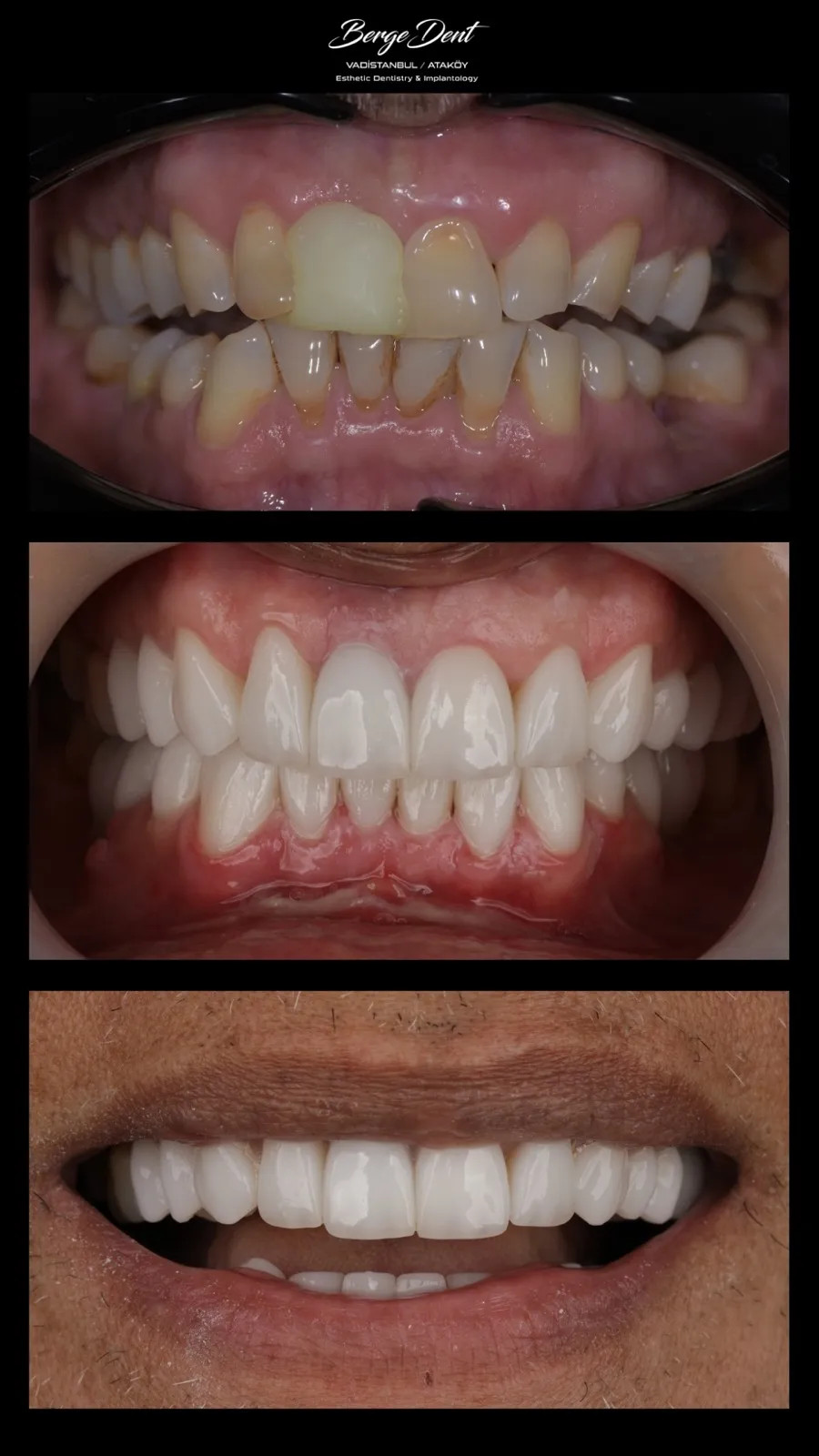 Before and after dental restoration close-up, worn discolored teeth replaced with uniform white crowns, Turkey dental clinic.