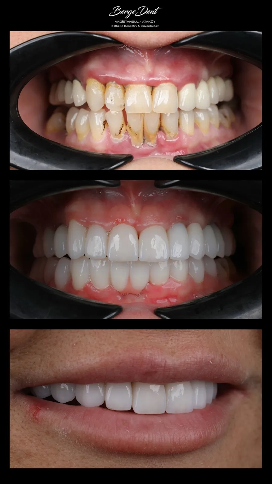 Dental before and after mouth close-up, stained and worn teeth transformed into bright even white restorations, Turkey dental clinic.