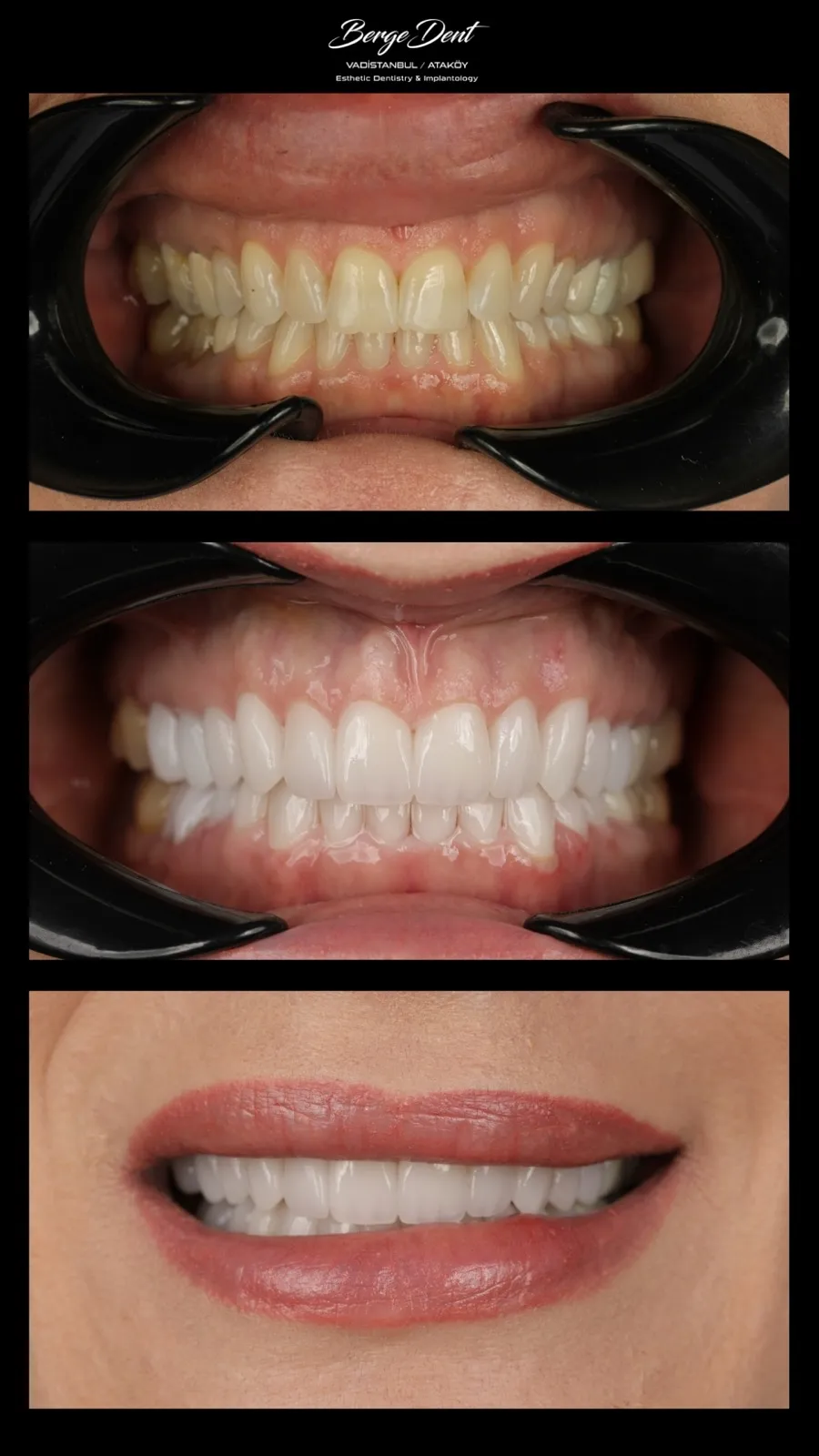 Before and after smile close-up, gapped and discolored teeth restored to a full bright white smile, Turkey dental clinic.