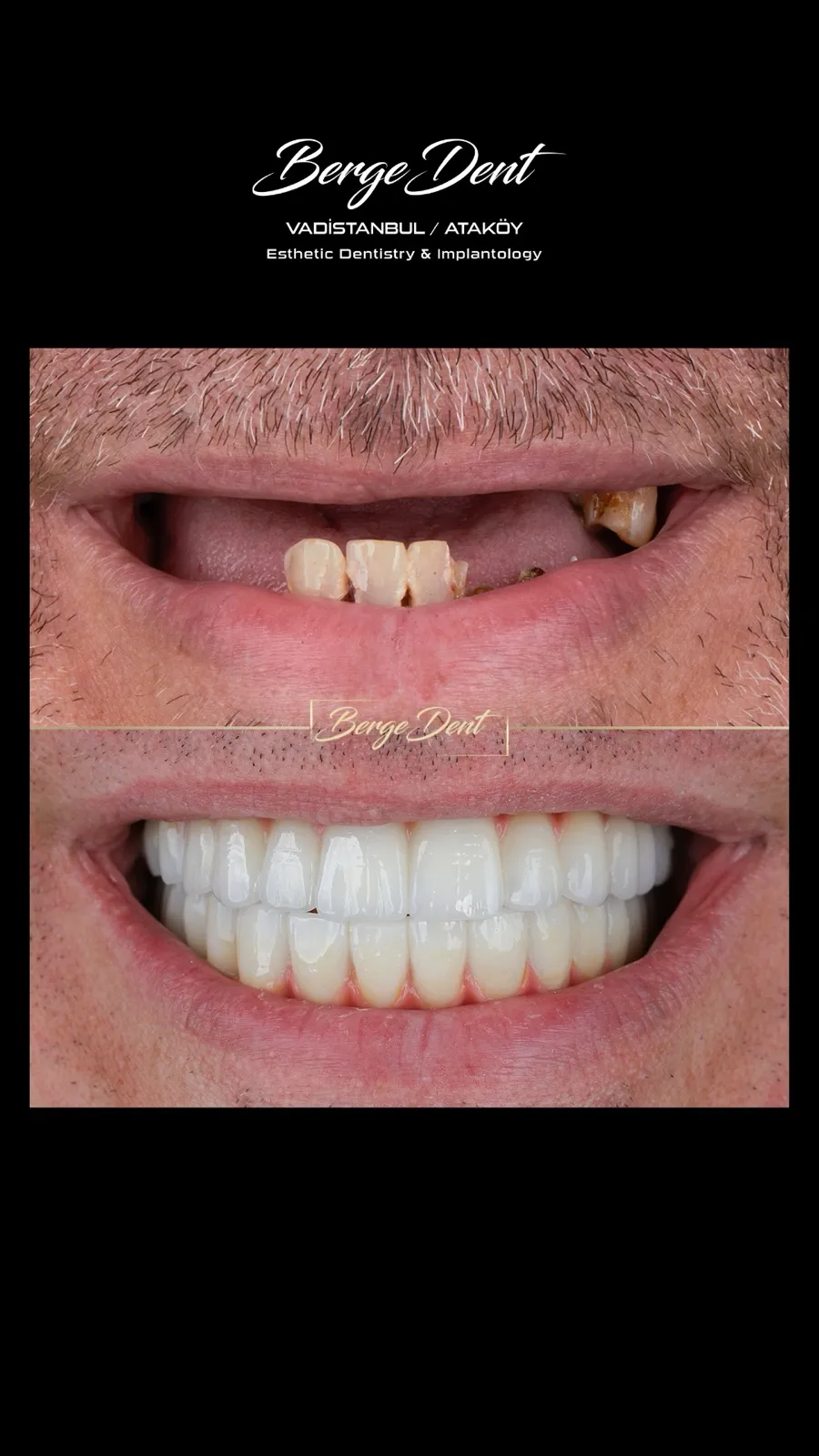 Male patient before and after dental treatment close-up, missing and broken front teeth restored with a full white smile, Turkey dental clinic.