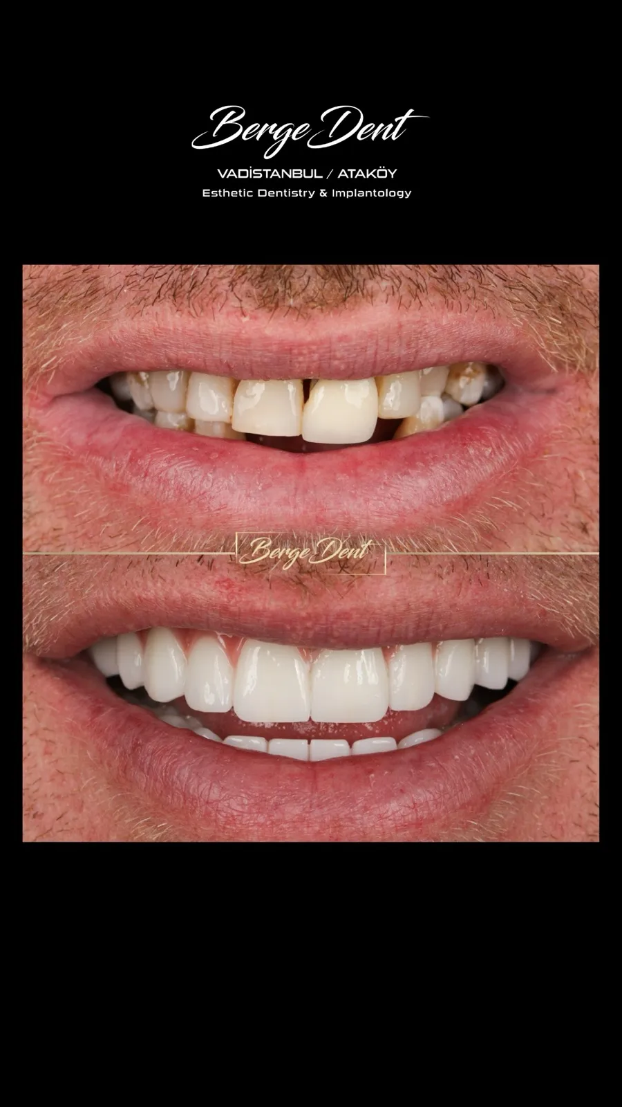Male patient before and after dental restoration close-up, chipped and gapped teeth transformed into an even white smile, Turkey dental clinic.