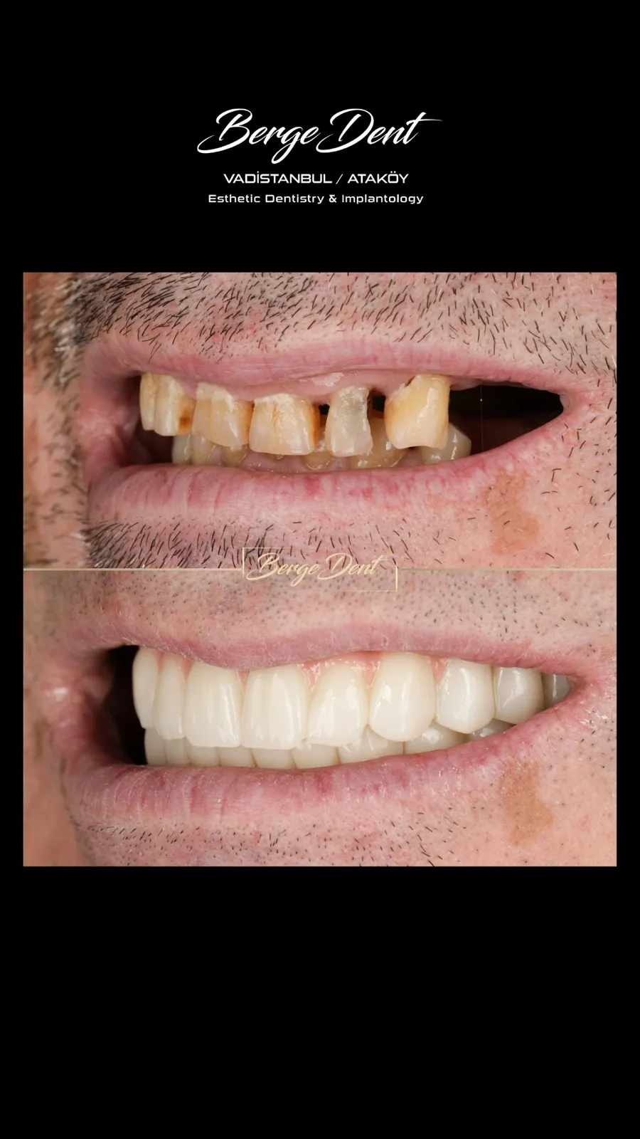 Side-angle before and after dental close-up, severely worn and stained teeth restored to a natural white smile, Turkey dental clinic.