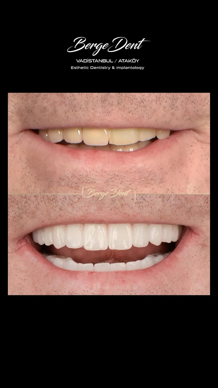 Male patient before and after dental close-up, gapped worn teeth restored to a uniform white smile, Turkey dental clinic.