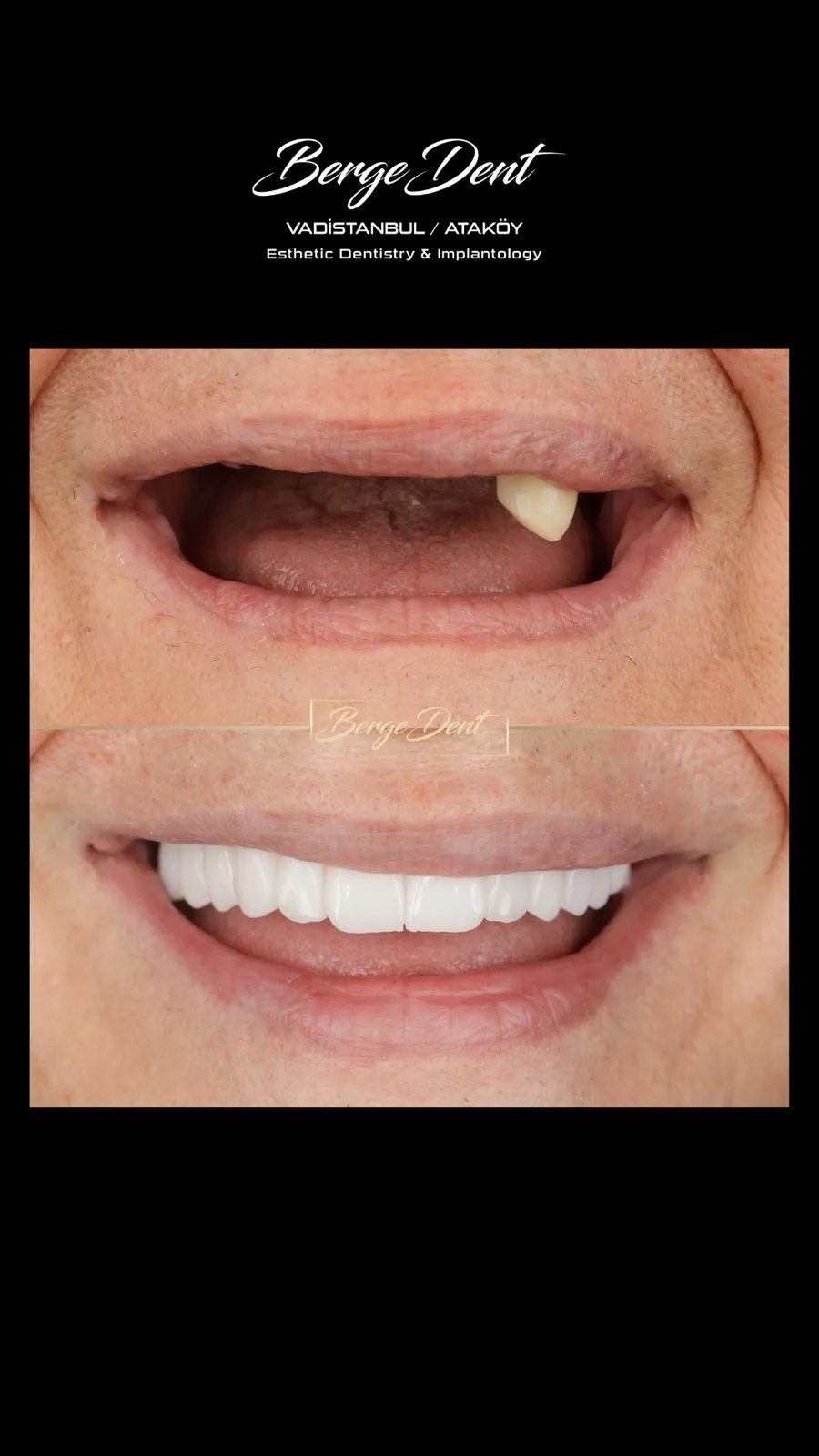 Male patient before and after dental close-up, single remaining tooth in upper arch restored with a full white smile, Turkey dental clinic.