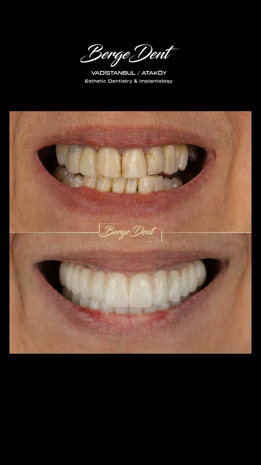 Male patient before and after dental close-up, worn discolored teeth with gaps restored into an even white smile, Turkey dental clinic.