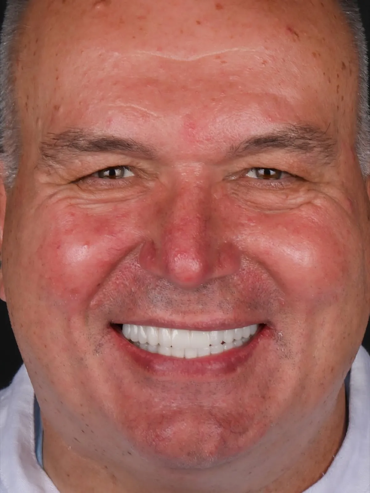 Full face portrait of a smiling senior man showing a bright, even dental restoration result, Turkey dental clinic.