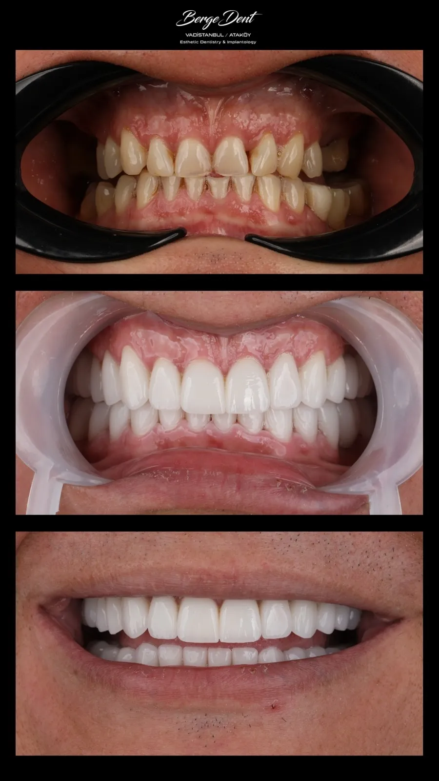 Close-up intraoral clinical photo of the tongue and lower oral cavity, part of a numbered clinical case photo series, Turkey dental clinic.