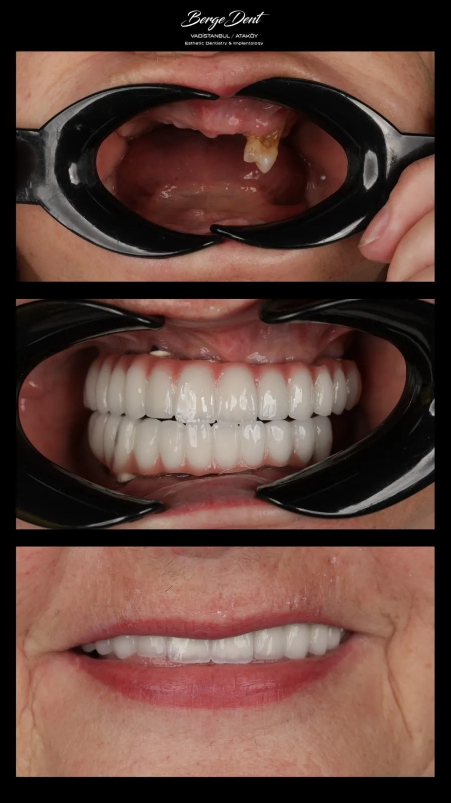 Before and after dental transformation: gapped, discolored teeth compared to a bright white full-arch restoration and natural smiling result, Turkey dental clinic.