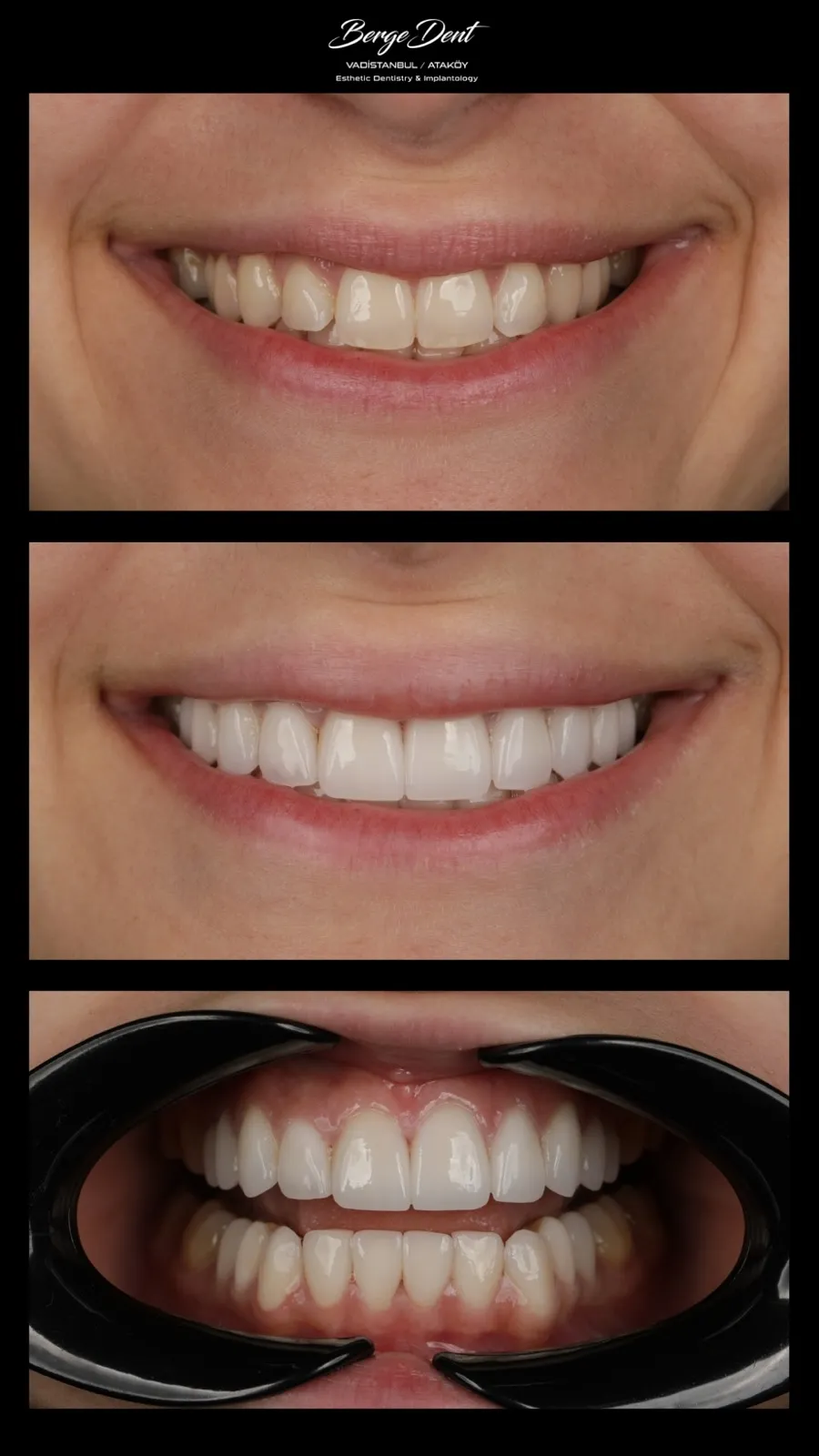 Before and after dental transformation: chipped, discolored front tooth compared to a bright white full-arch restoration and natural smiling result, Turkey dental clinic.