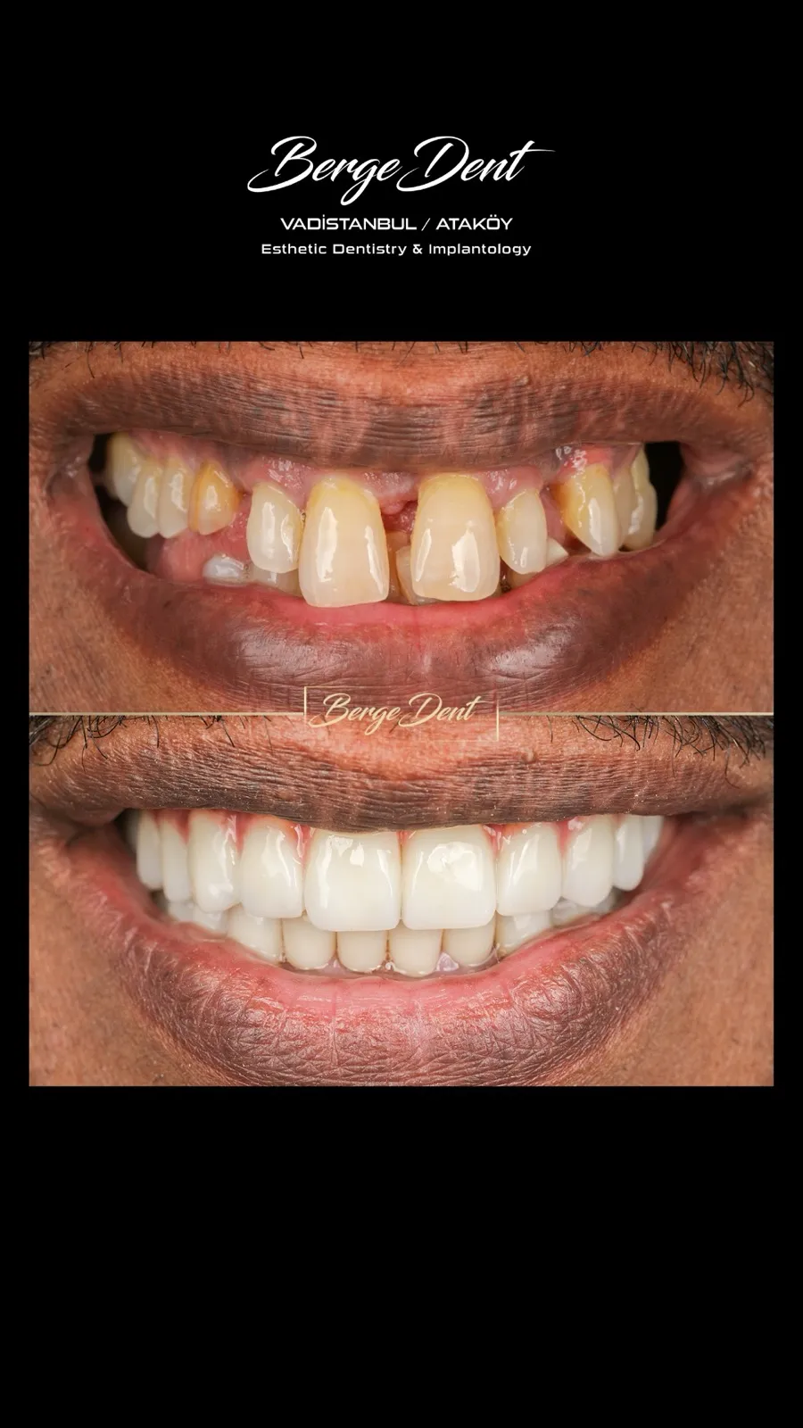 Before and after dental transformation: gapped teeth with a missing tooth compared to a bright white complete smile restoration, Turkey dental clinic.