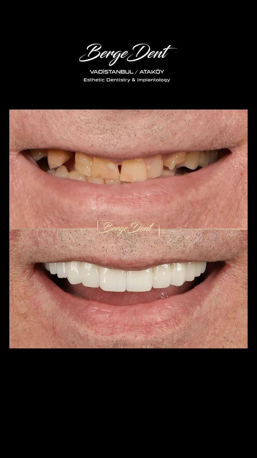 Before and after dental transformation: severely worn and broken teeth with gaps compared to a bright white complete smile restoration, Turkey dental clinic.