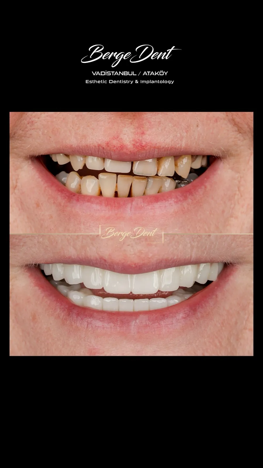 Before and after dental transformation: severely broken and decayed teeth with gaps compared to a bright white complete smile restoration, Turkey dental clinic.