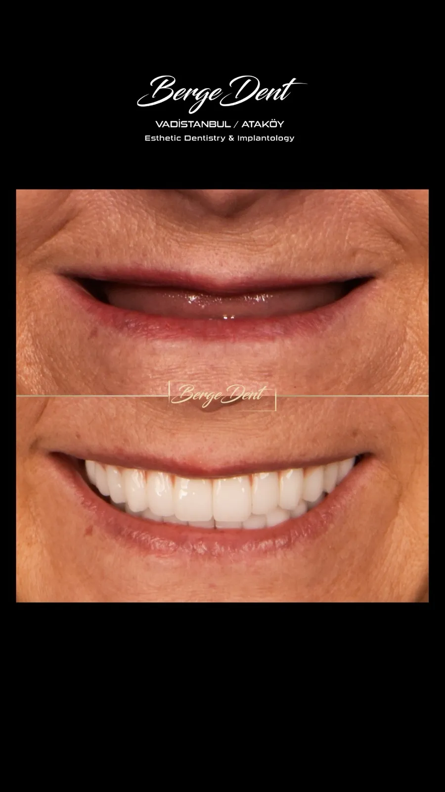 Before and after dental transformation, lower face view: closed natural lips compared to an open bright white smile after full-arch restoration, Turkey dental clinic.