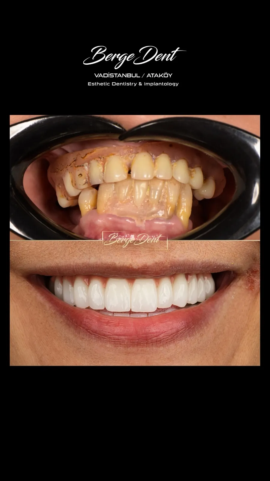 Before and after dental transformation: heavily decayed and tartar-covered teeth compared to a bright white full-arch restoration, Turkey dental clinic.
