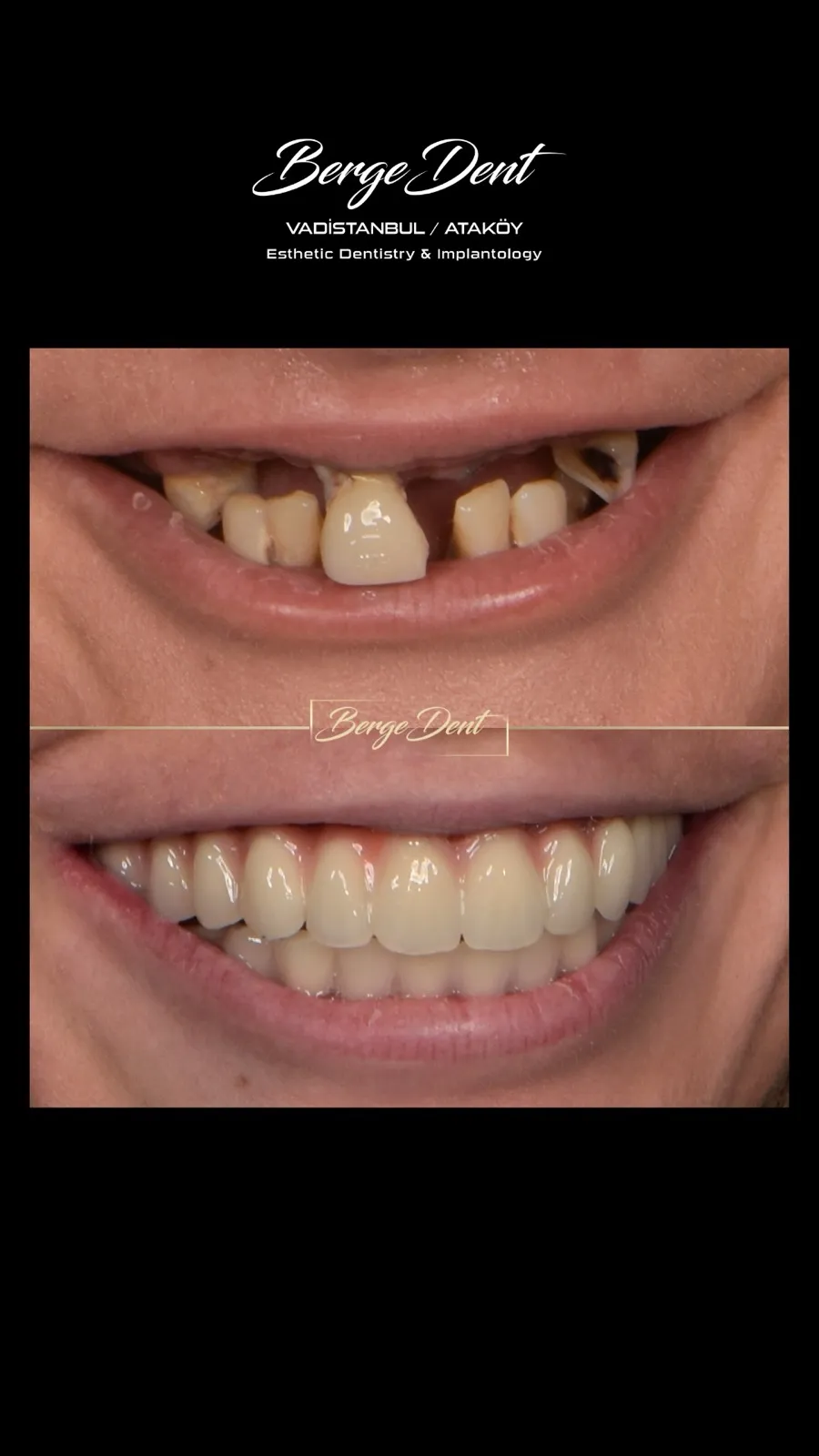 Before and after dental transformation: missing and worn front teeth compared to a complete, evenly aligned white smile restoration, Turkey dental clinic.
