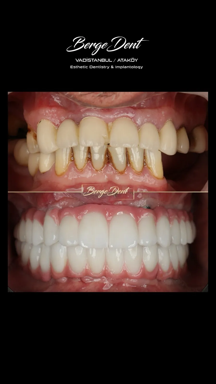 Before and after dental transformation: severely worn and discolored teeth compared to a bright white full-arch restoration, Turkey dental clinic.